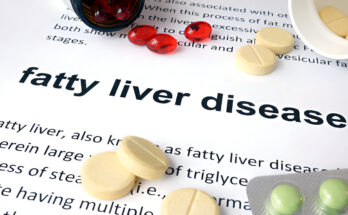 Natural Ways to Reduce the Risk of Fatty Liver Disease: Exploring Fruits, Tea, and Other Superfoods